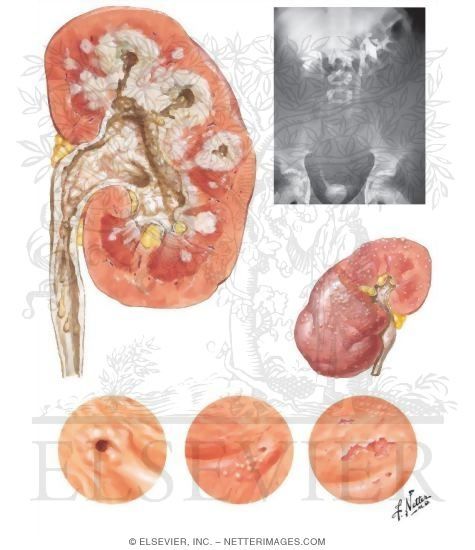 Urinary Tuberculosis