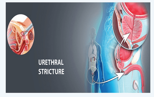 Stricture urethra treatment